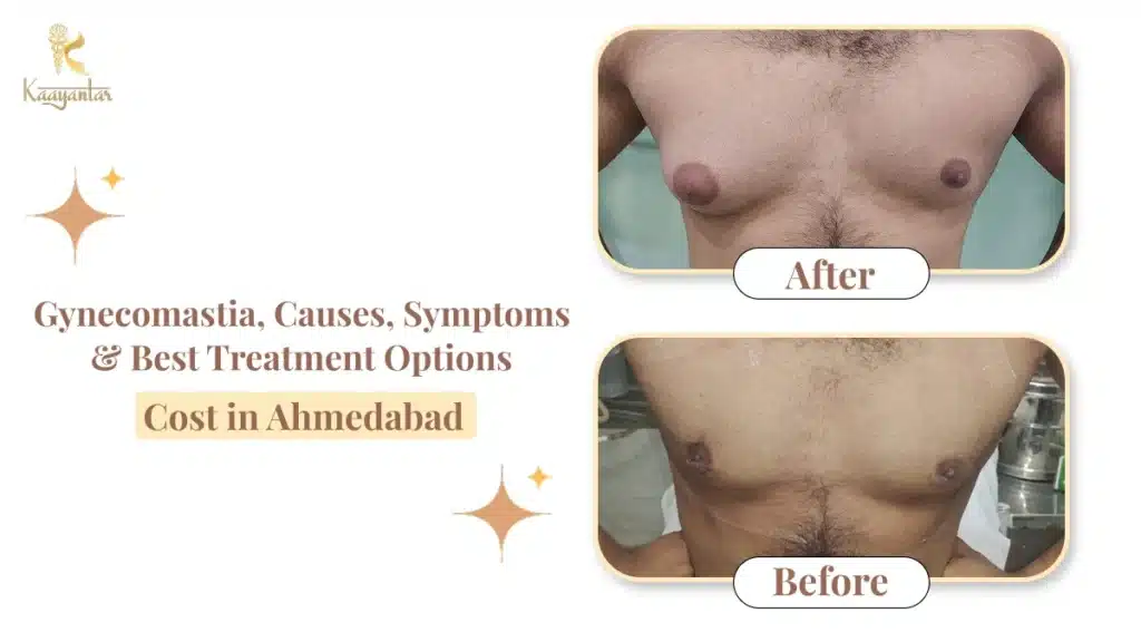 Gynecomastia, Causes, Symptoms & Best Treatment Options