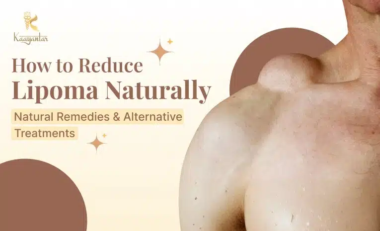 How to Reduce Lipoma Naturally