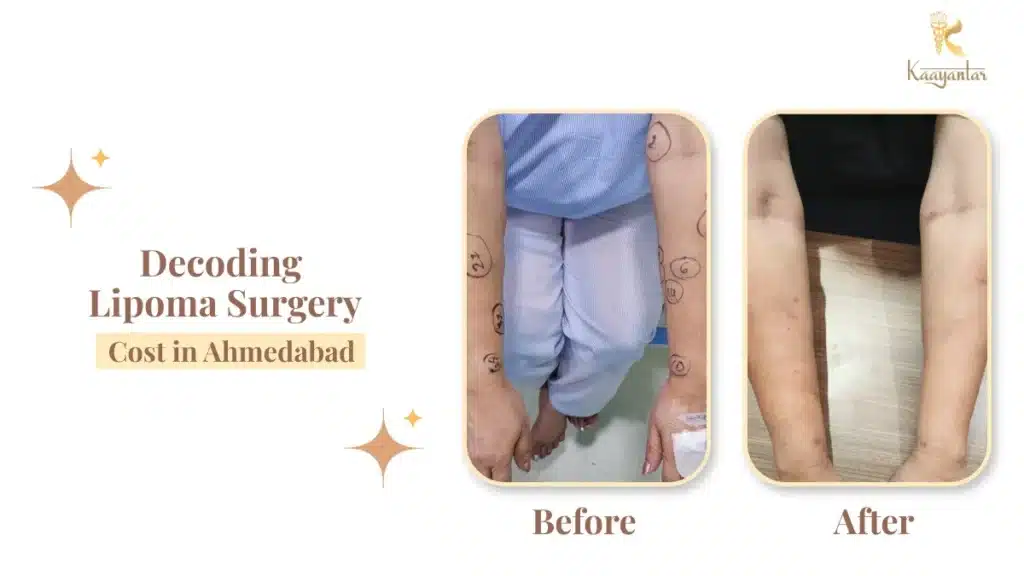 Lipoma, Causes, Symptoms & Best Treatment Options