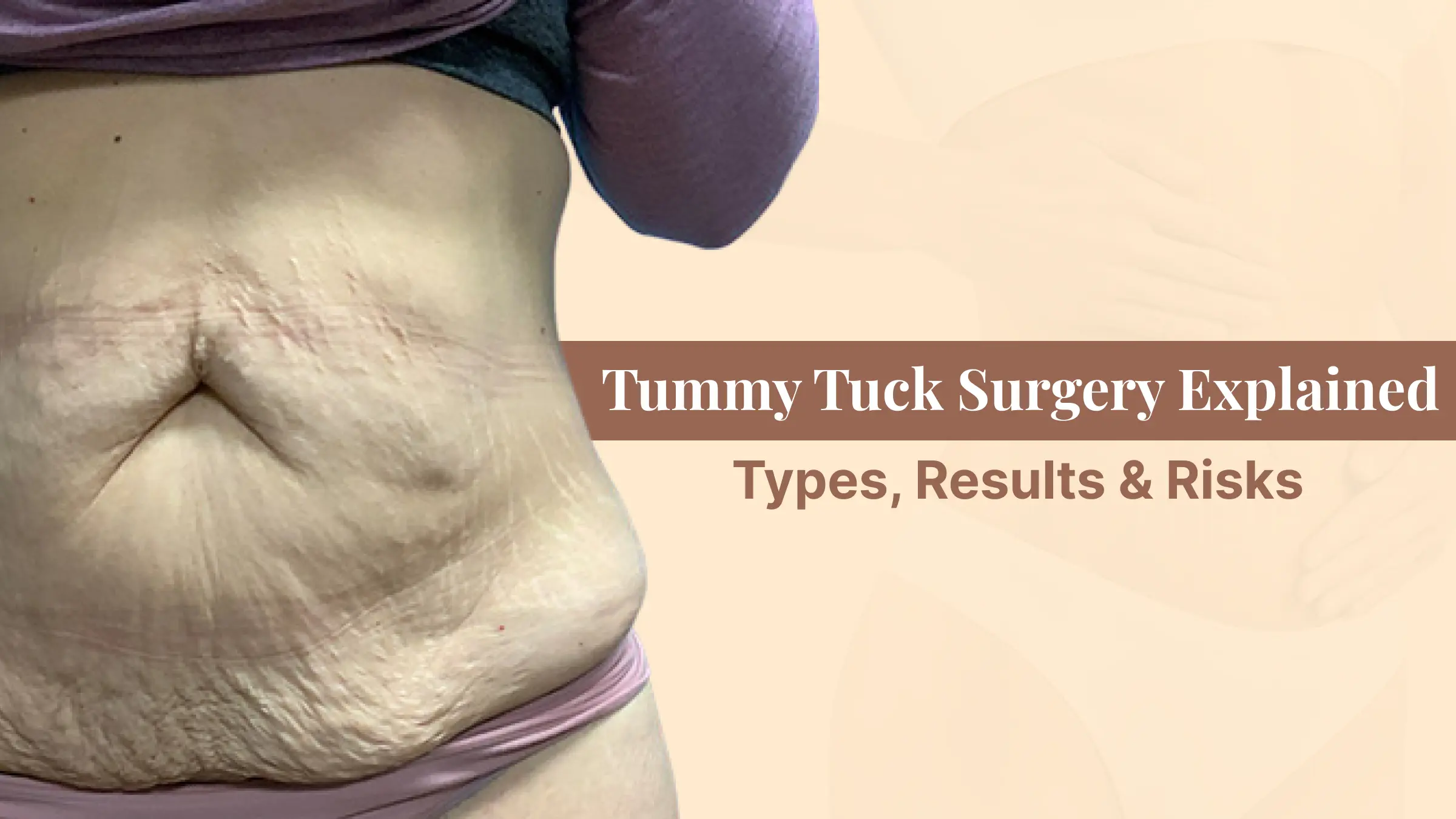 Tummy Tuck Surgery in Ahmedabad