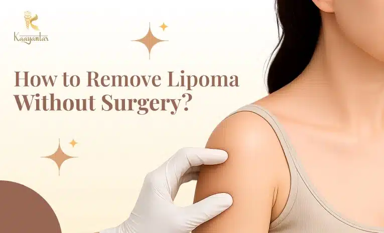 How to Remove Lipoma Without Surgery