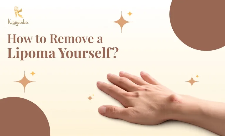 How to Remove a Lipoma Yourself