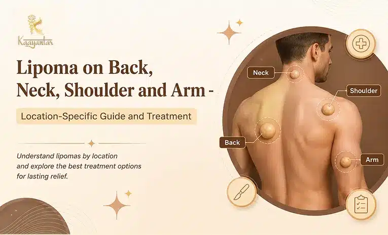 Lipoma on Back